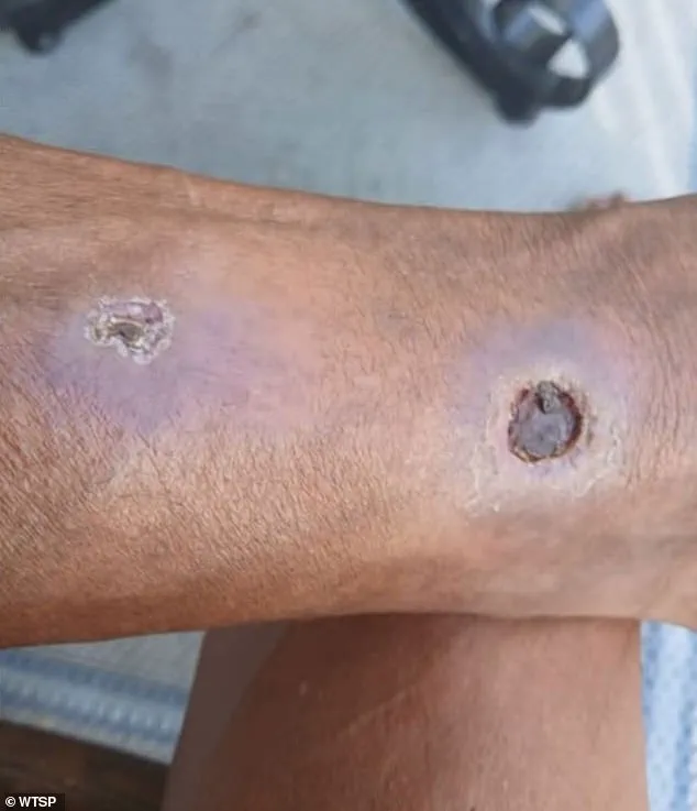 Florida Woman Sues Apartment Complex Over Alleged Neglect in Spider Infestation Leading to Amputation