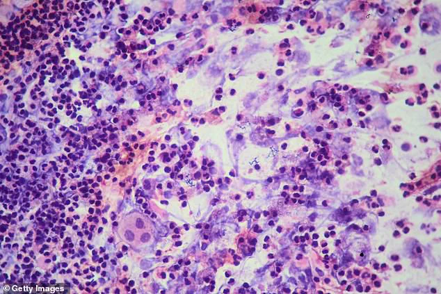 Third Tuberculosis Case Confirmed at Archbishop Riordan High School, Prompting Public Health Advisory