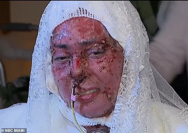 From Burn Trauma to Wedding Vows: Arianna Esquiline's Remarkable Recovery After Miami Grill Accident