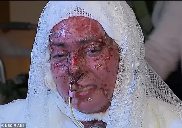 From Burn Trauma to Wedding Vows: Arianna Esquiline's Remarkable Recovery After Miami Grill Accident