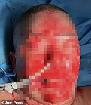 Rare Lamotrigine Reaction Leaves Woman with Severe Facial Burns, Scarring
