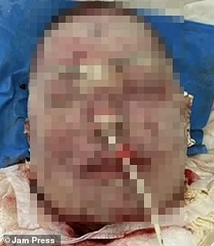 Rare Lamotrigine Reaction Leaves Woman with Severe Facial Burns, Scarring