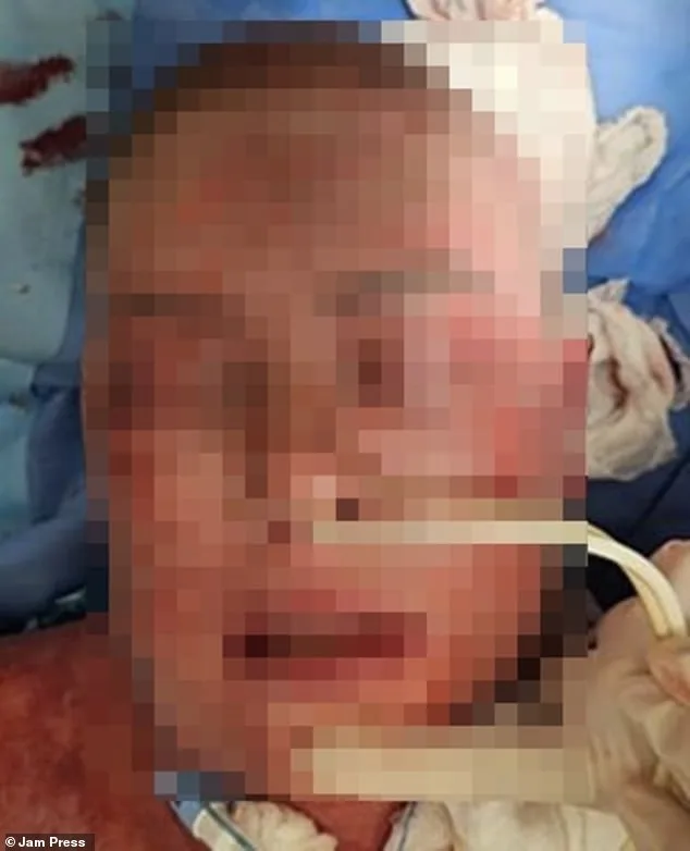 Rare Lamotrigine Reaction Leaves Woman with Severe Facial Burns, Scarring