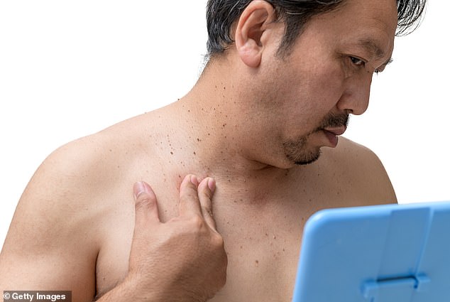 Sudden Skin Tag Clusters May Signal Insulin Resistance and Diabetes Risk