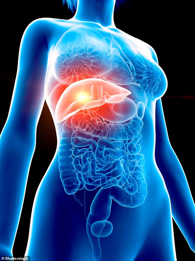 Fatty Livers Significantly Increase Risk of Aggressive Bowel Cancer