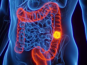 Fatty Livers Significantly Increase Risk of Aggressive Bowel Cancer