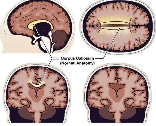 From Fiction to Reality: The Real Condition Behind Severance's Split Consciousness