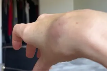 Tara Rule Claims American Airlines Refused to Assist with Carry-On, Leading to Hand Injury and Bruises