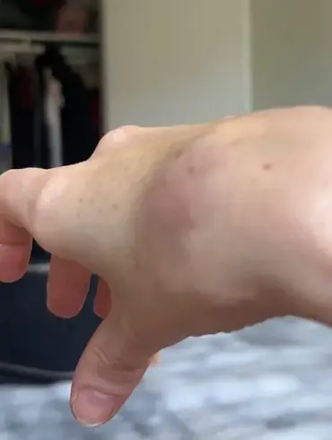 Tara Rule Claims American Airlines Refused to Assist with Carry-On, Leading to Hand Injury and Bruises